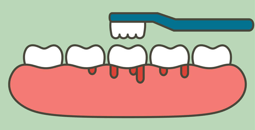 علائم خونریزی و تورم لثه